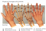 arthritisps