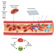 sickle-cell-diagram